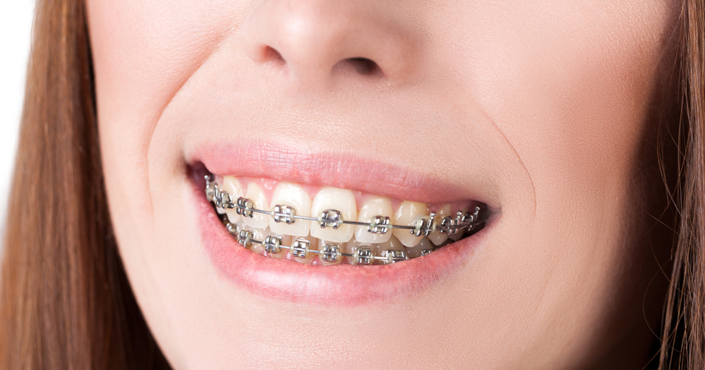braces-blog_021515