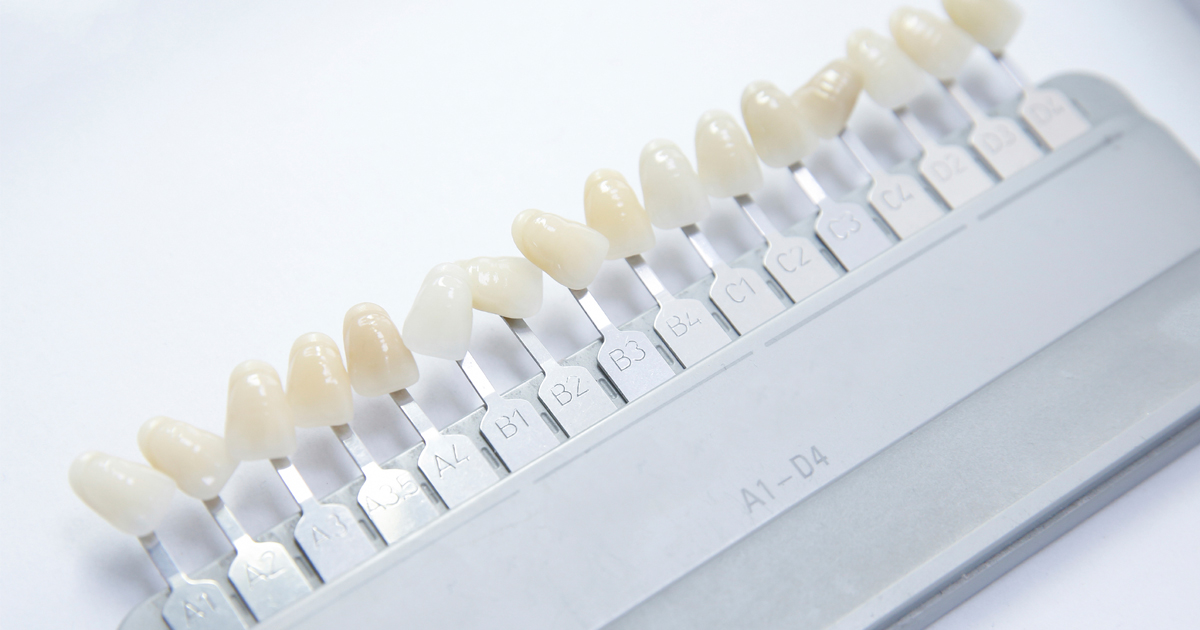 dca-blog_article-14_dental-veneers_1200x630