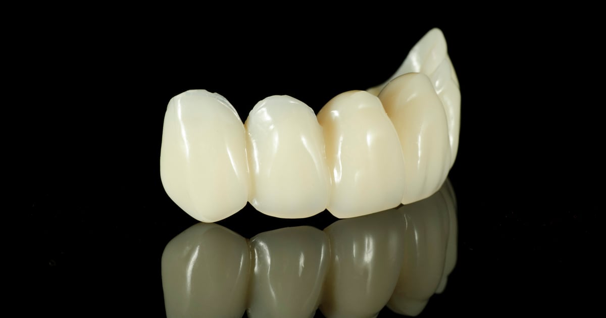 dca-blog_article-28_dental-bridges_1200x630